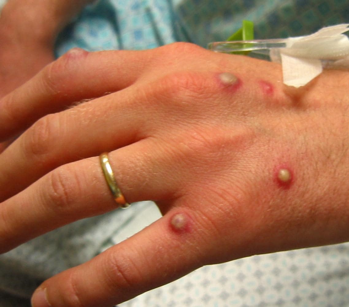 Monkeypox rash