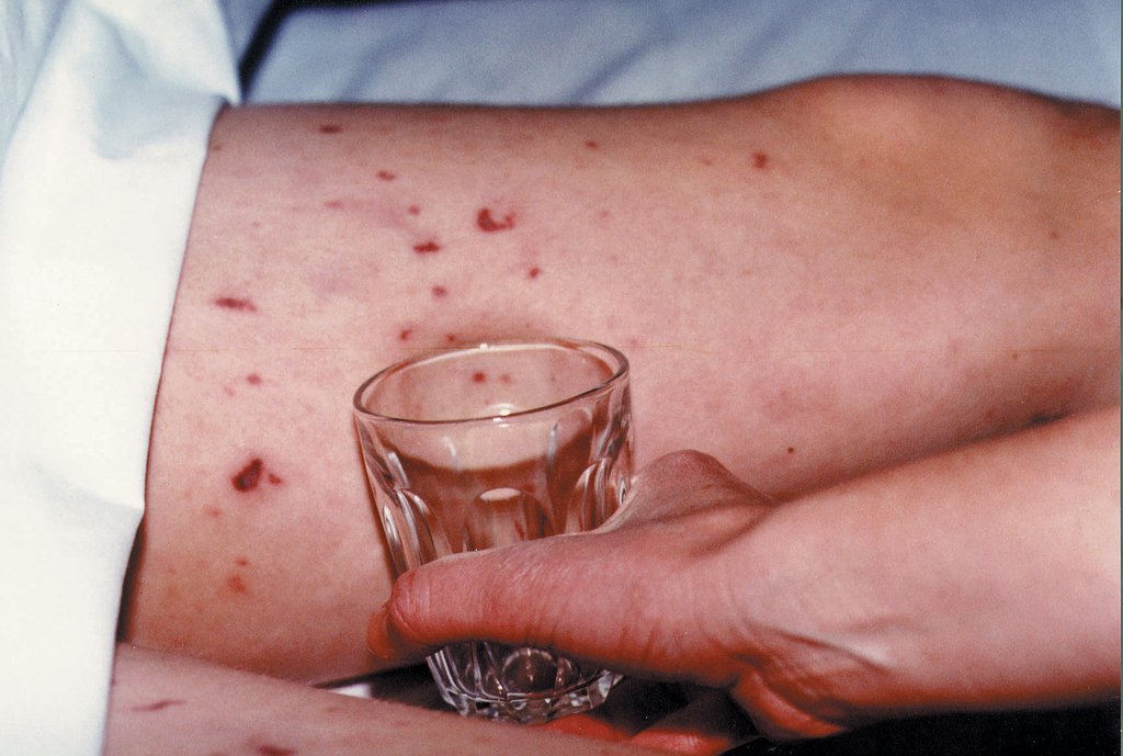 meningococcal rash test